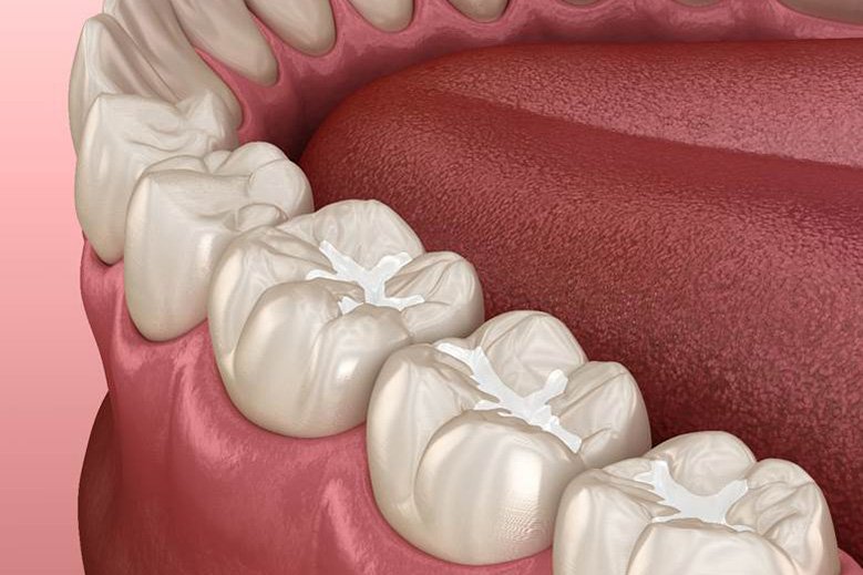 What Are Tooth Coloured Fillings?
